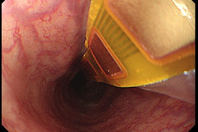 內視鏡食道黏膜電阻抗測量儀上的氣球與微晶片進到人體食道內